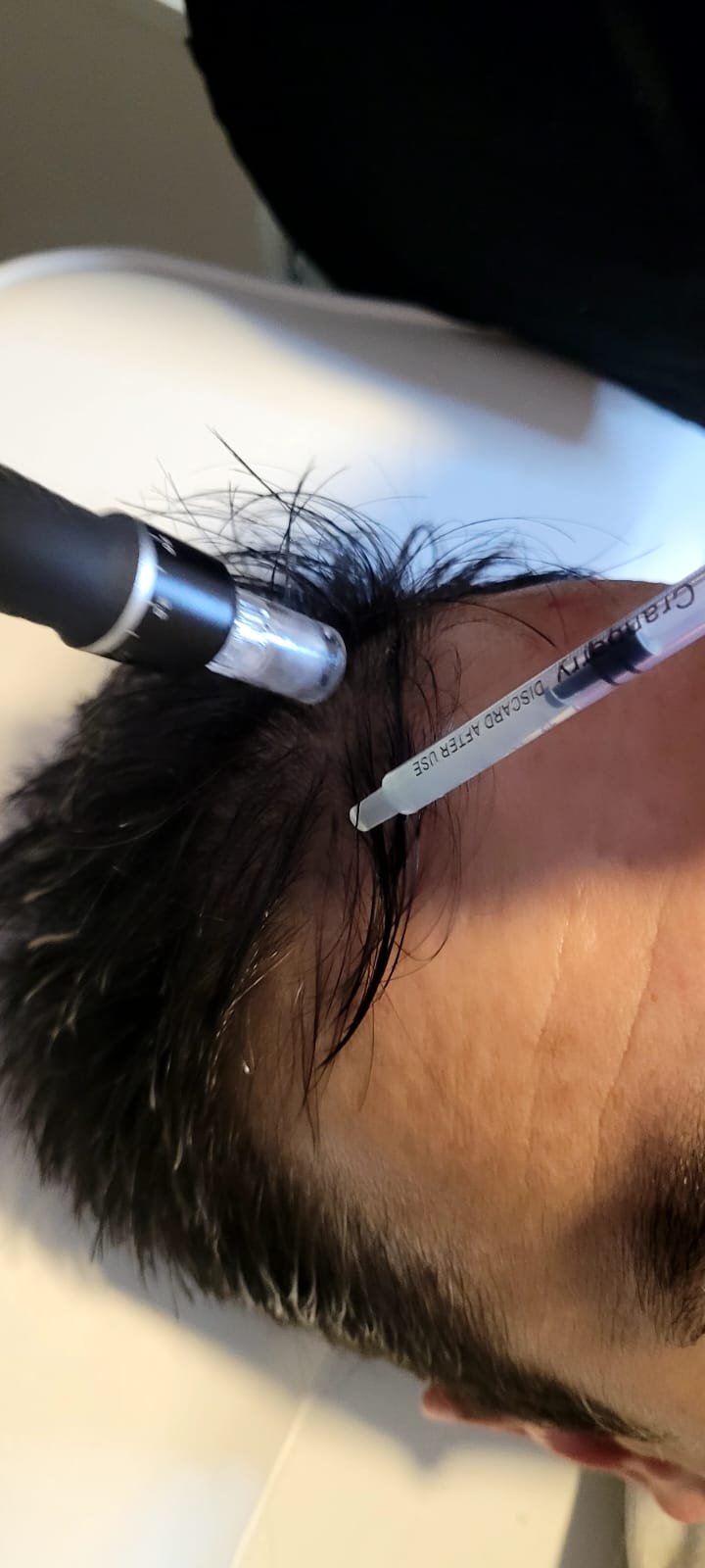 Práctica de microneedling capilar en curso EK Salud y Estética